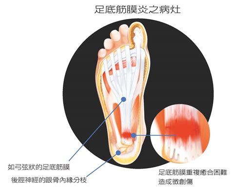 吱腳板底|腳底痛都是足底筋膜炎嗎？圖解腳底板痛的可能病症